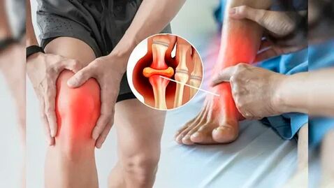 Участъци от кожата, подходящи за нанасяне на Icexin гел (колена, лакти, кръст)