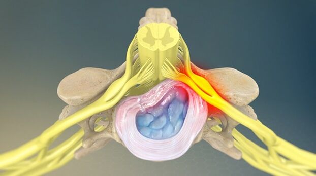 радикуларен синдром като причина за болка в кръста